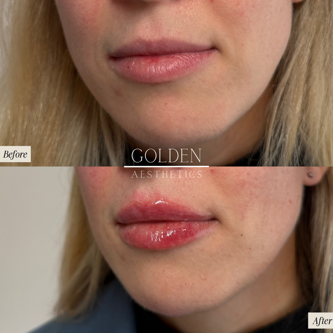 Lip Filler Golden Aesthetics East Aurora.png
