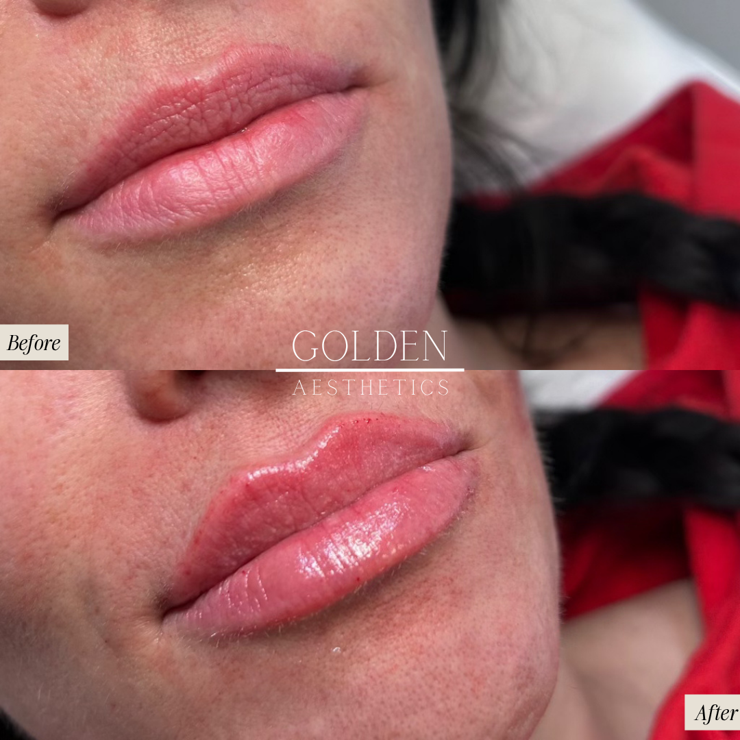 Lip Filler Golden Aesthetics East Aurora NY.png