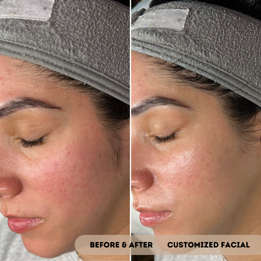 Signs of A Compromised Skin Barrier