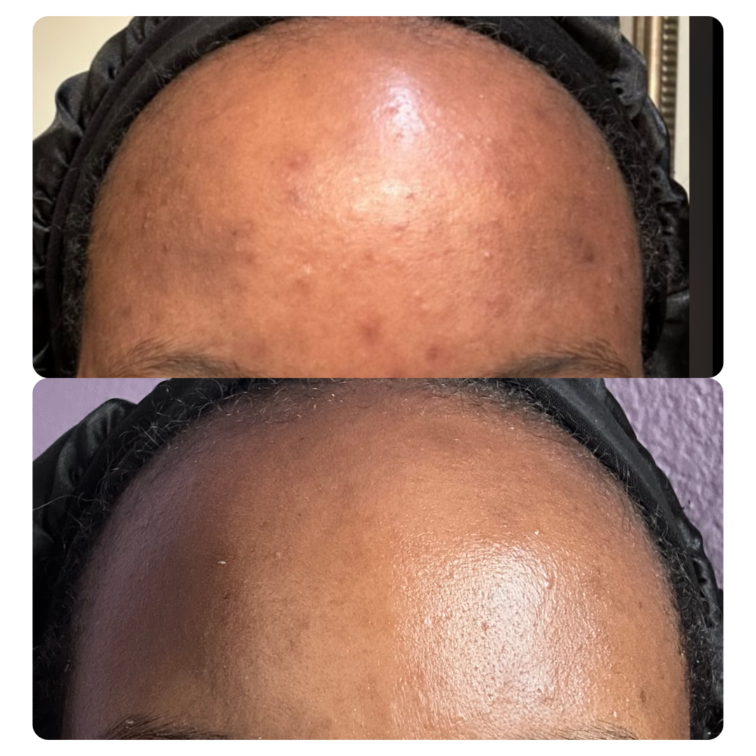 fading dark spots after acne, acne scarring