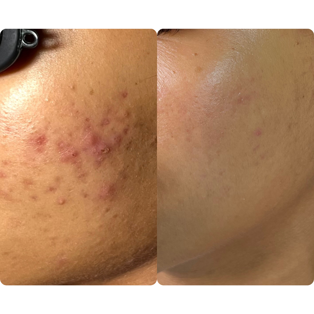 before and after acne clearing