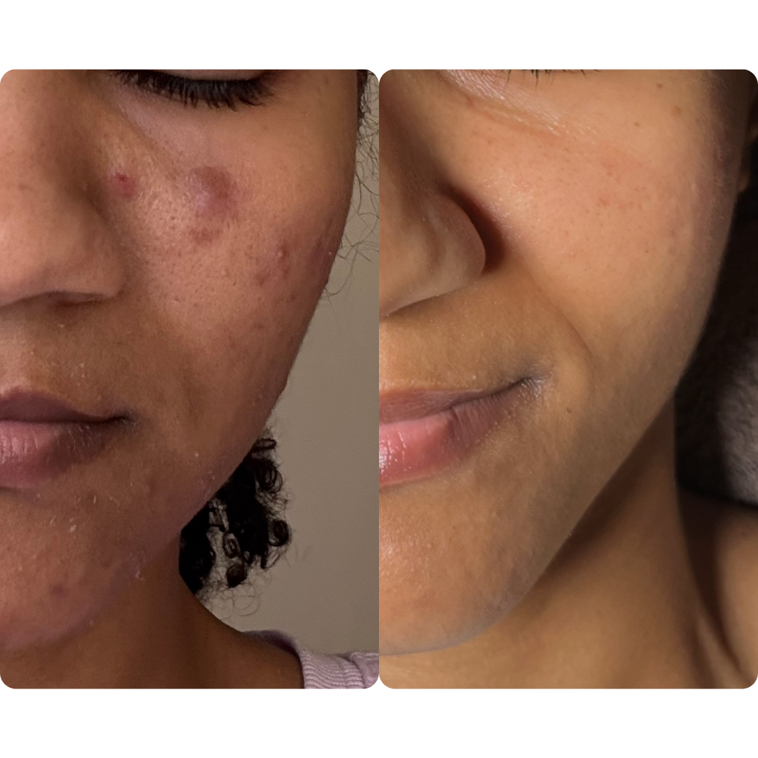 clearing acne and dark spots inland empire
