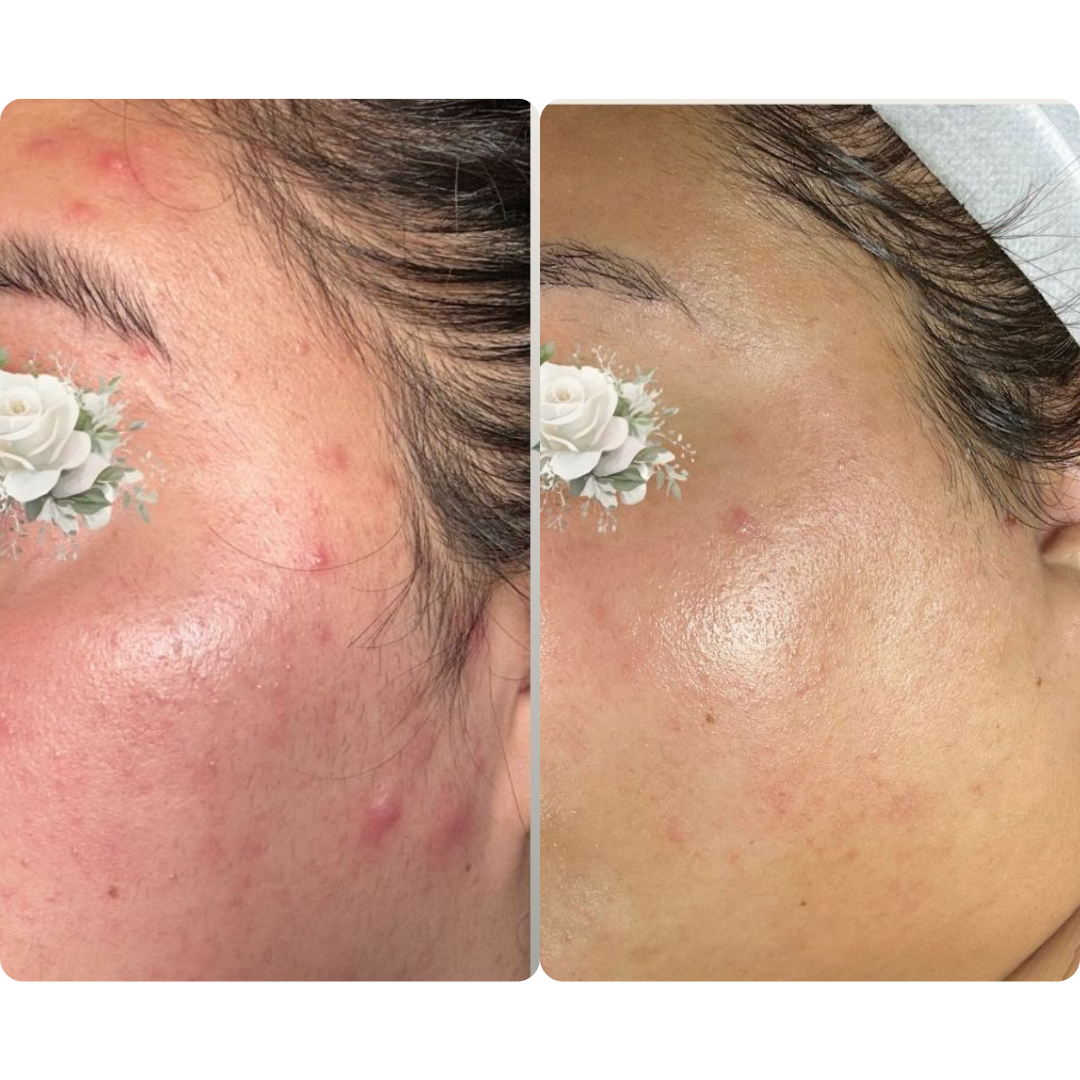 calm inflammation, clear acne, before and after