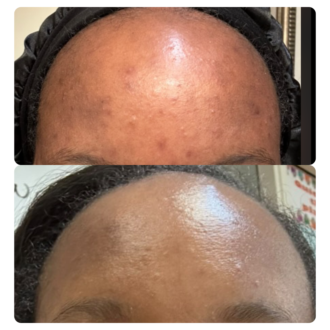fade acne scarring pigmentation