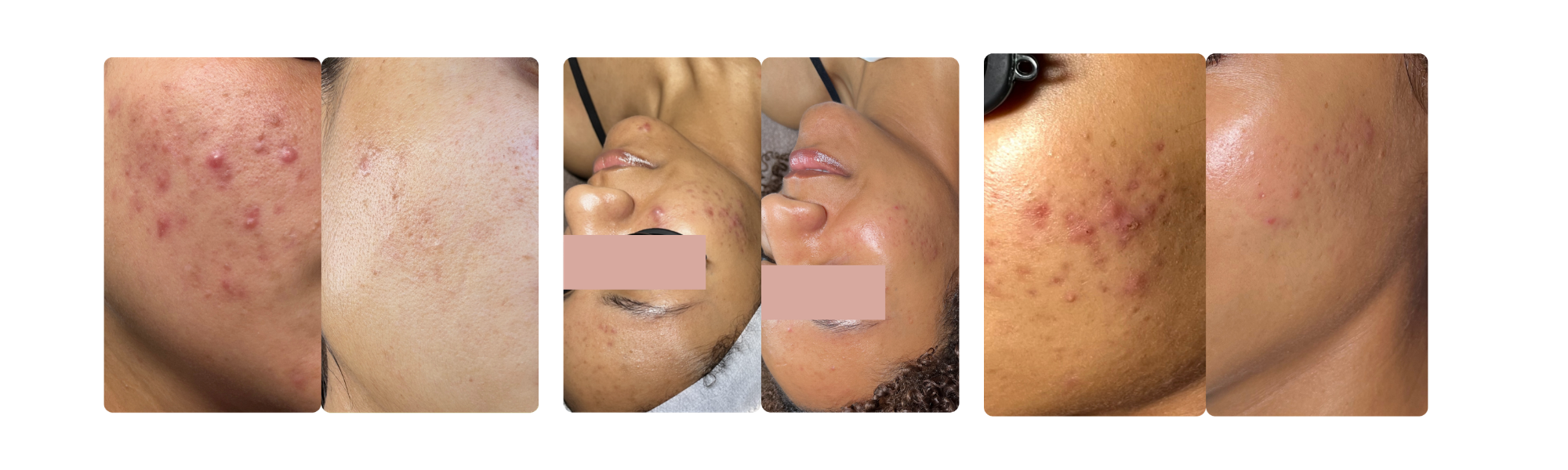 acne facials in the inland empire