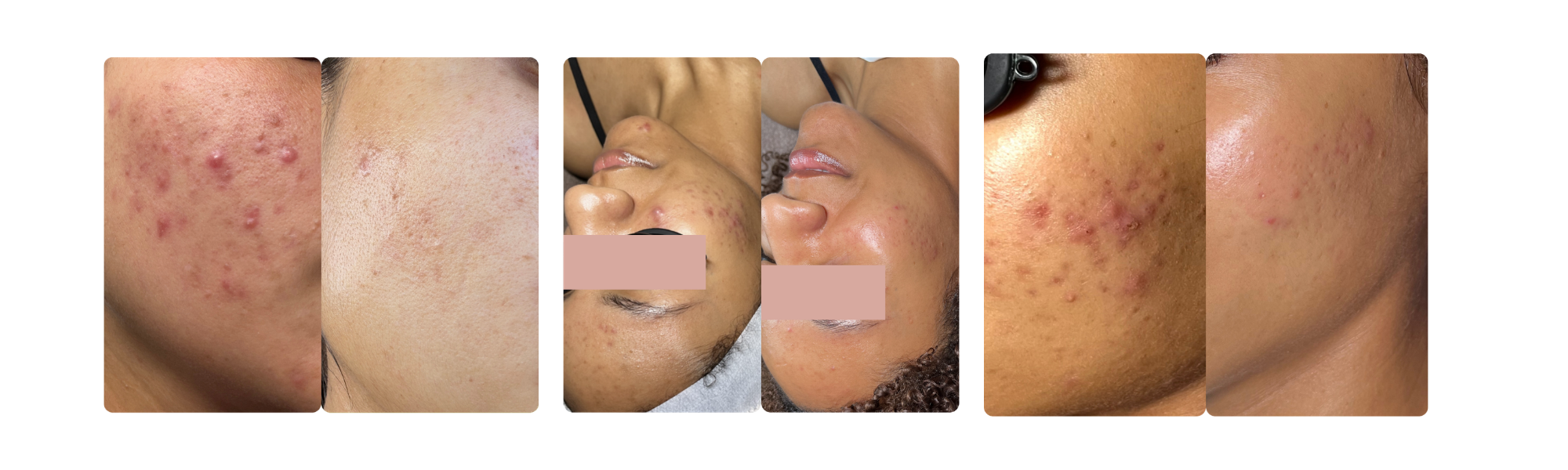 Clear skin before and after in the IE