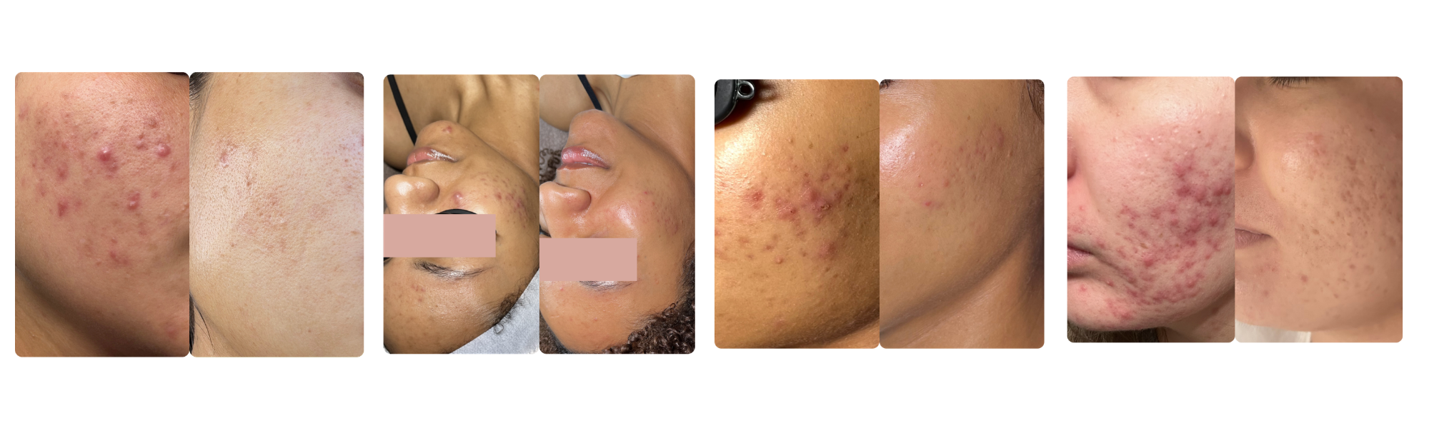 facial treatments in the inland empire . acne specialist