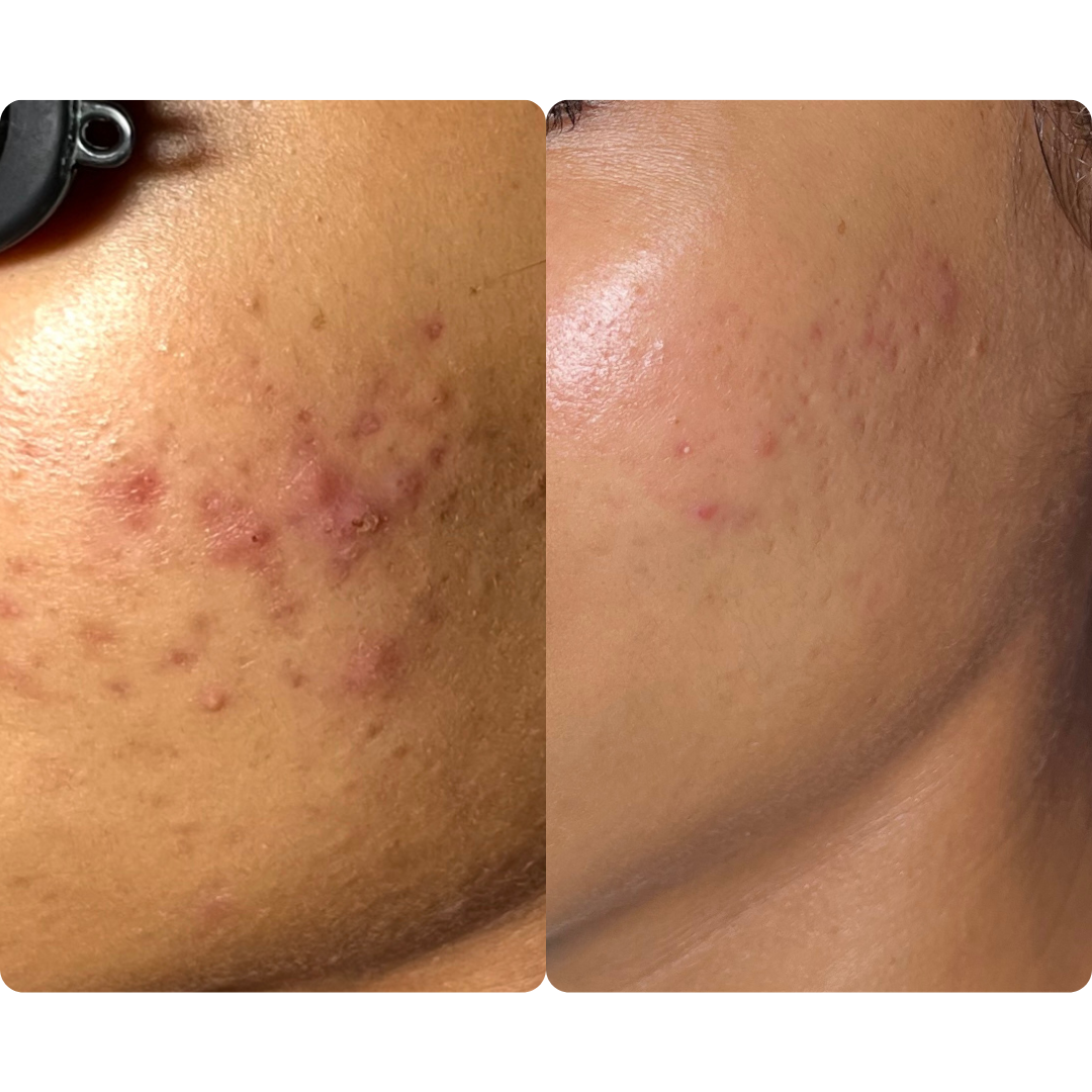 before and after acne progress picture