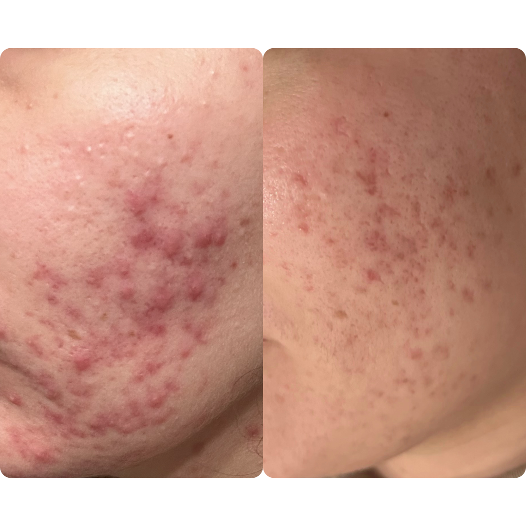 acne treatment progress picture