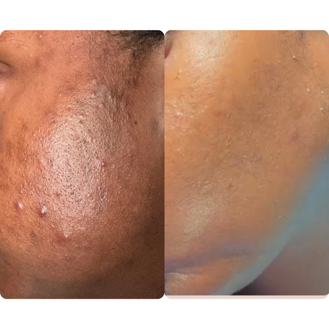 clearing acne on dark skin