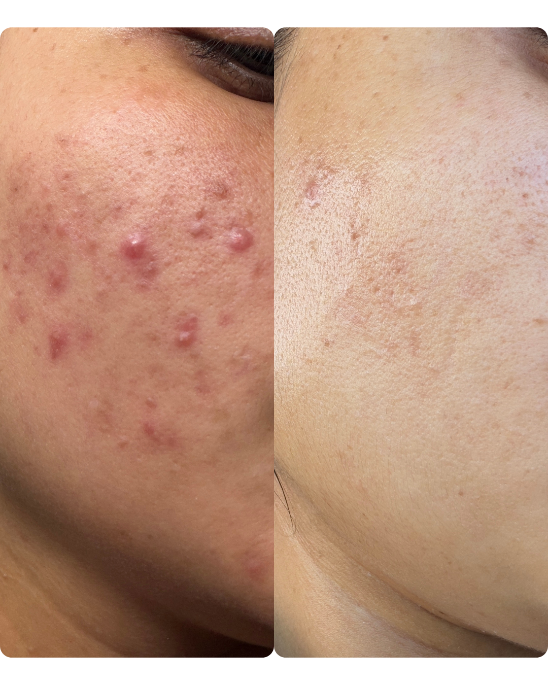 acne treatments in Fontana , acne treatments near me