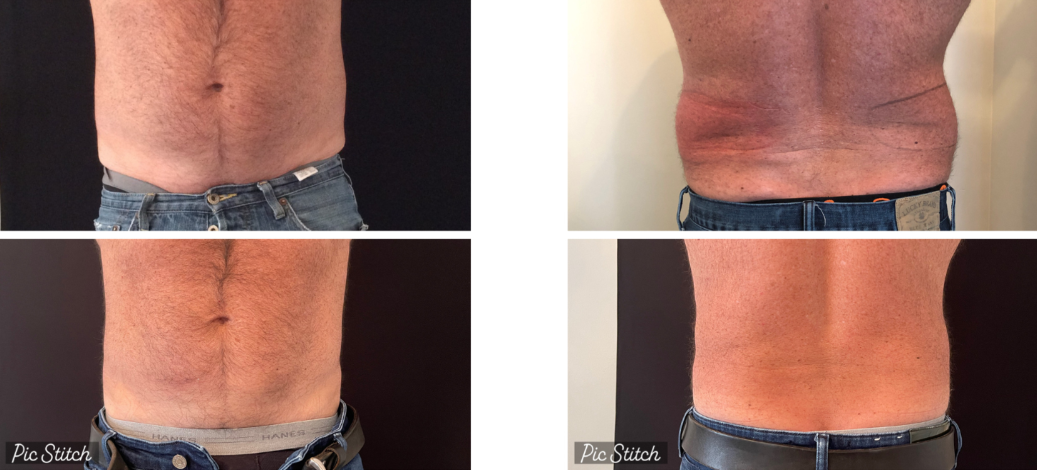 Eterna-BeforeAfter-Coolsculpting2.png