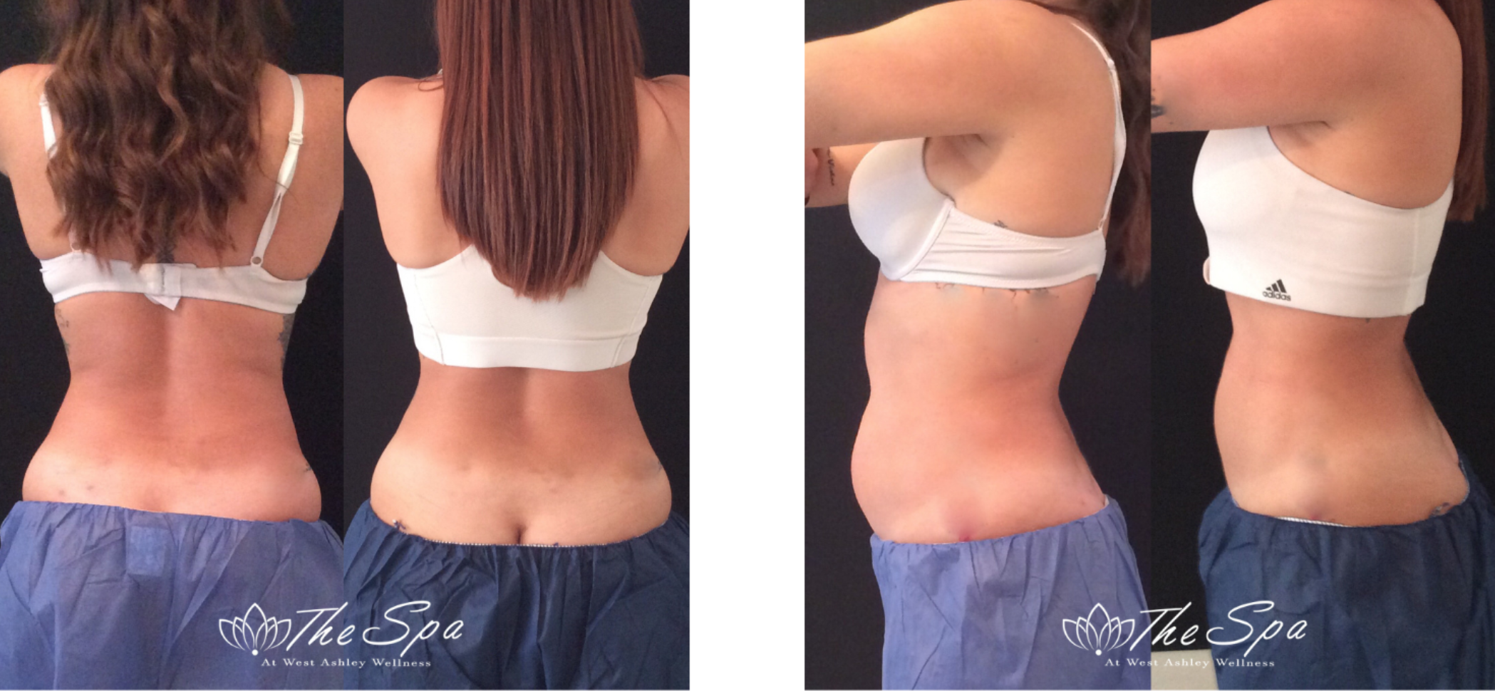 Eterna-BeforeAfter-Coolsculpting1.png