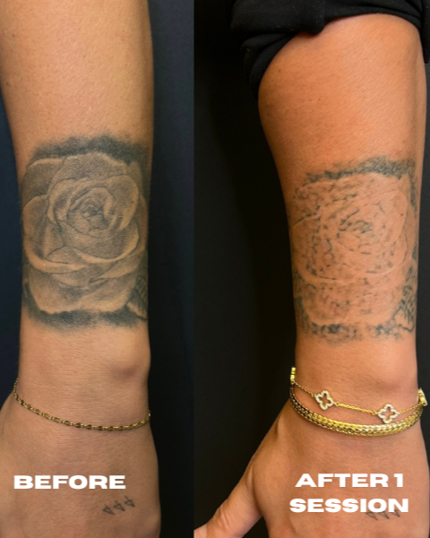 Comparison of a tattoo of a rose on a person's arm before and after a tattoo removal session. The 'before' shows a clear, detailed rose tattoo, while the 'after' shows the tattoo fading significantly, with the skin appearing healed and less ink visib