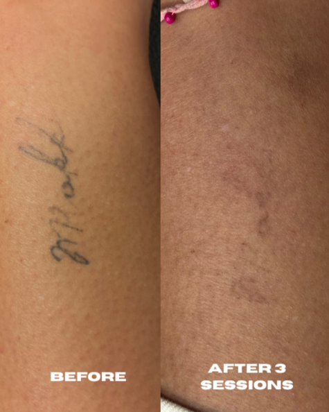 Comparison of skin before and after three sessions showing fading of tattoo