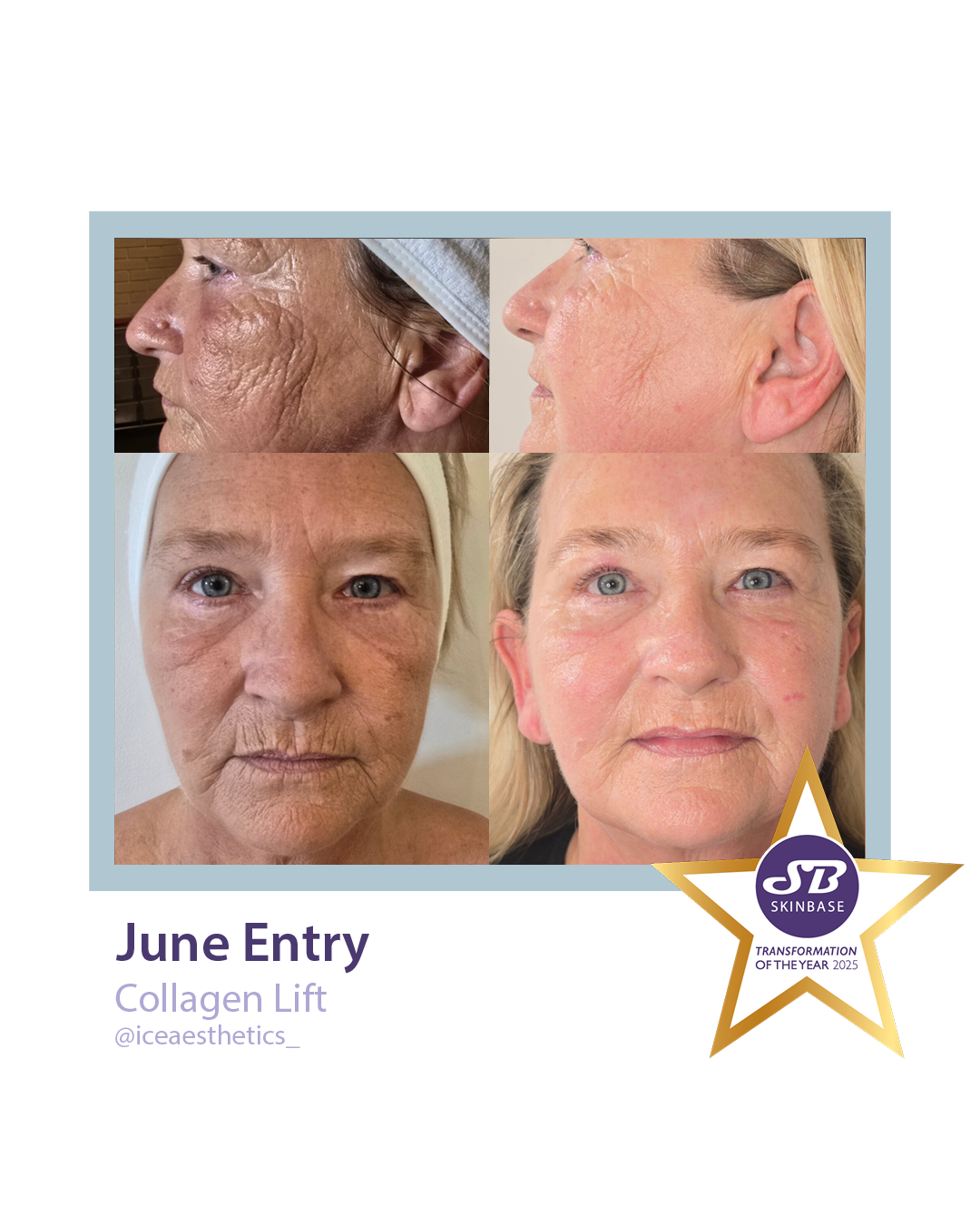 JuneIceAestheticsCollagenLift.png