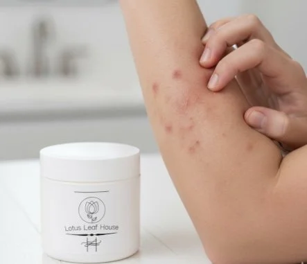 Soothe and Hydrate: Your Guide to Eczema Relief