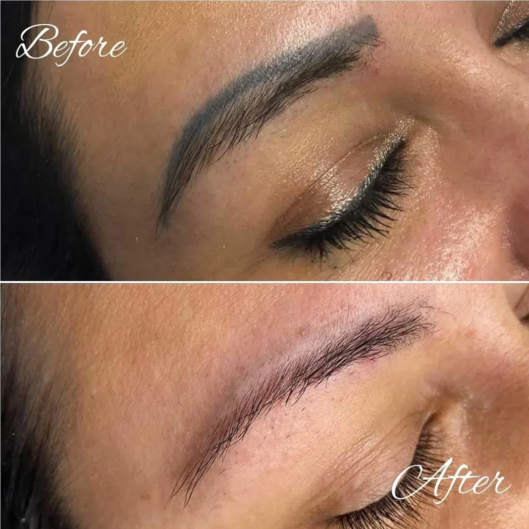 Magnetic Tattoo Removal - Before and After
