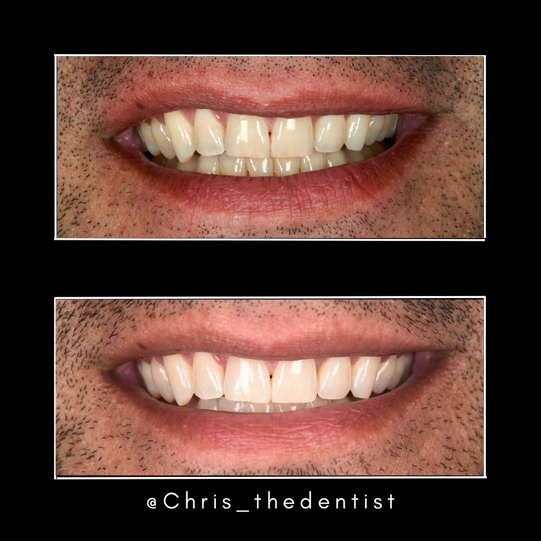 Transform your smile with our professional teeth whitening treatment! Swipe to see the stunning before and after results. Ready to brighten your smile? Book your appointment today! ✨😁 #teethwhitening #smilebright #beforeandafter #enlightensmiles