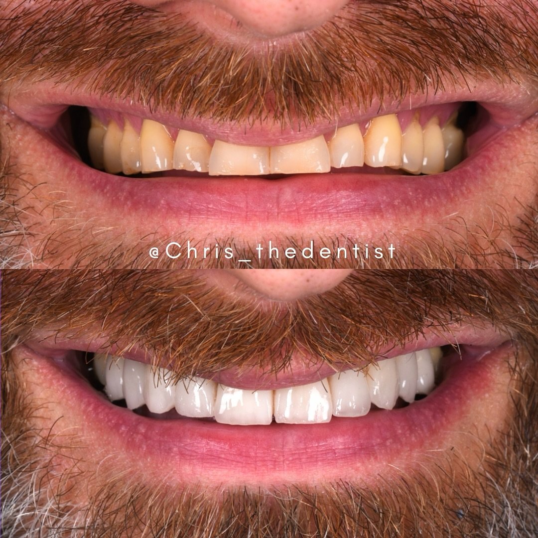 This is a Smile Makeover!

After years of tooth wear and erosion, our patient felt that he had lost his smile. He disliked the colour and the shape of his teeth, often feeling as if he was hiding his smile. No one really mentioned the options or solu
