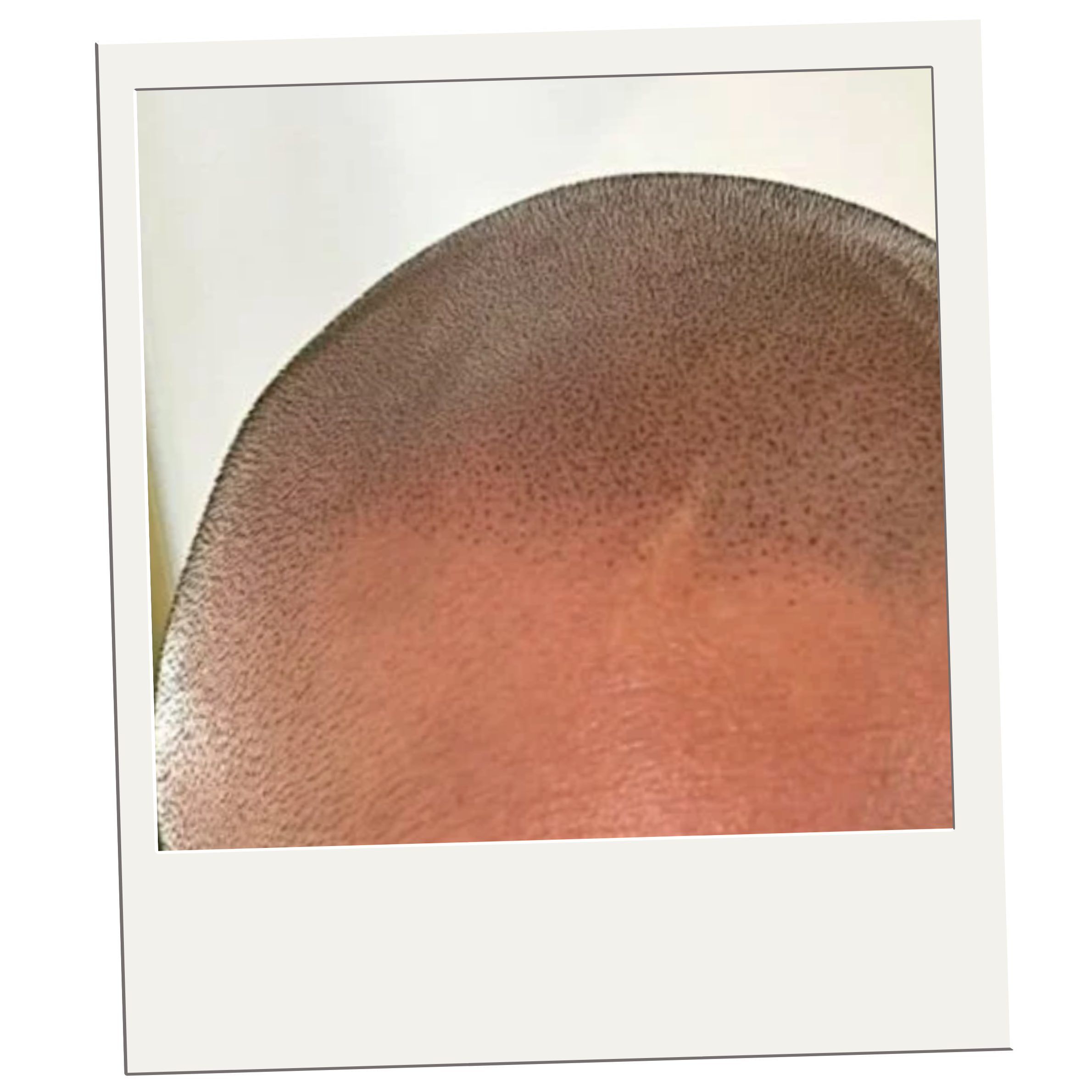 Scalp Micropigmentation