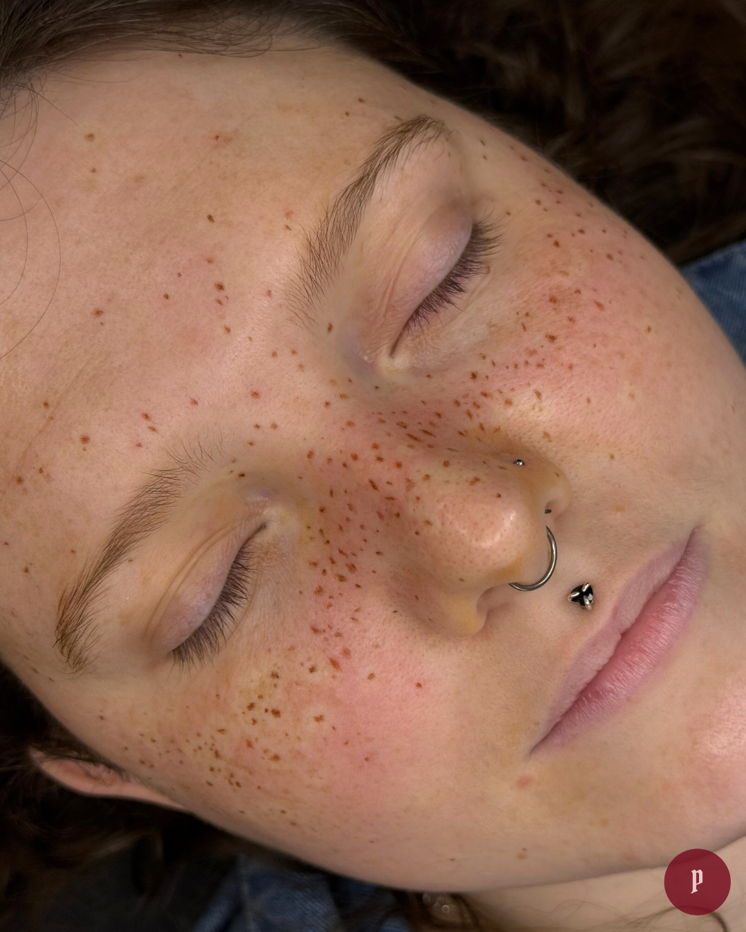 freckle tattooing melbourne
