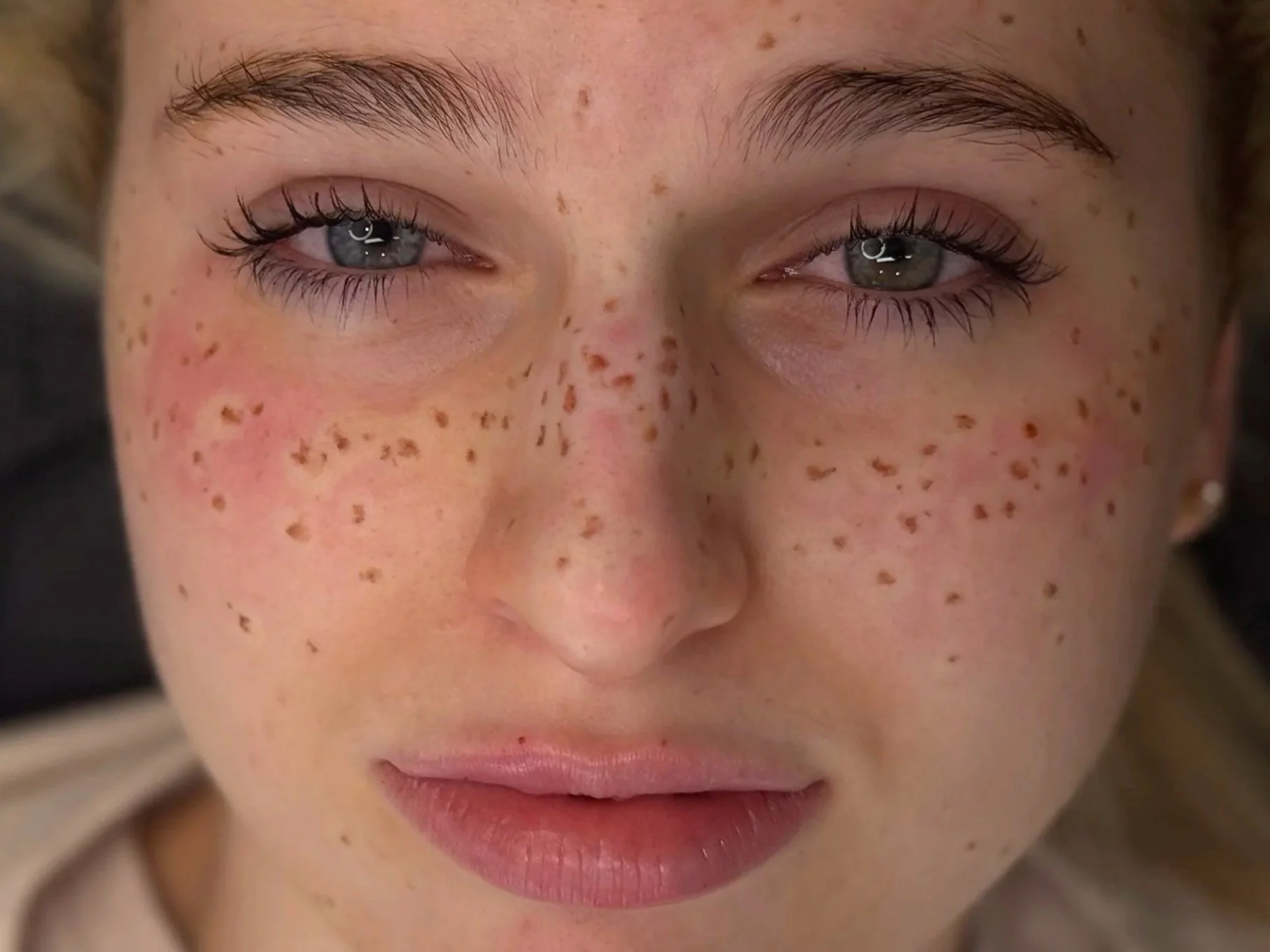 Freckles