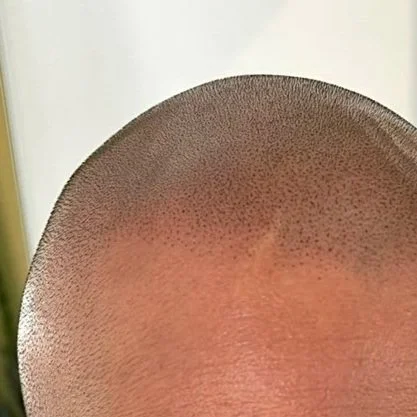 Scalp Micropigmentation