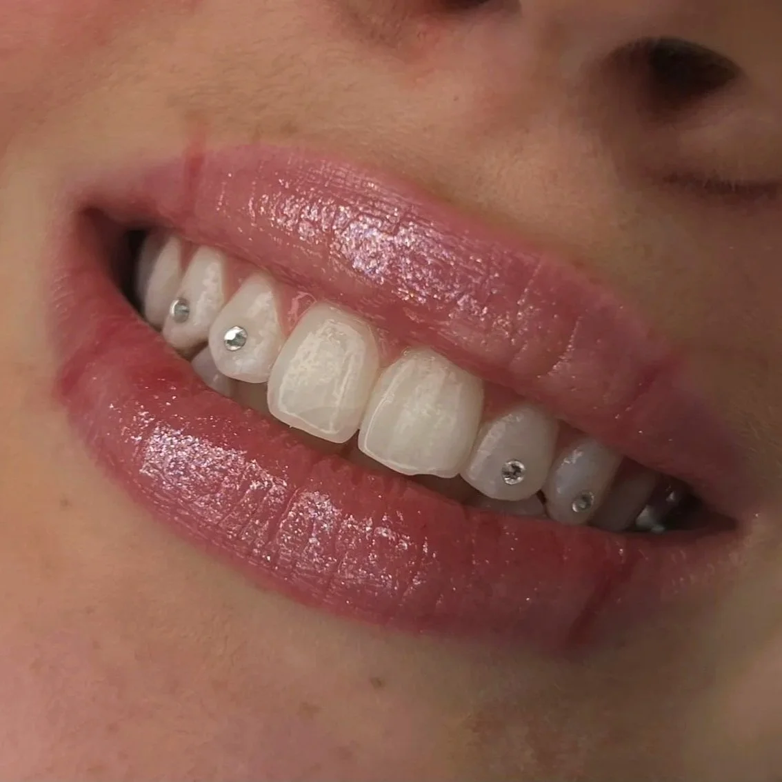 Tooth Gems