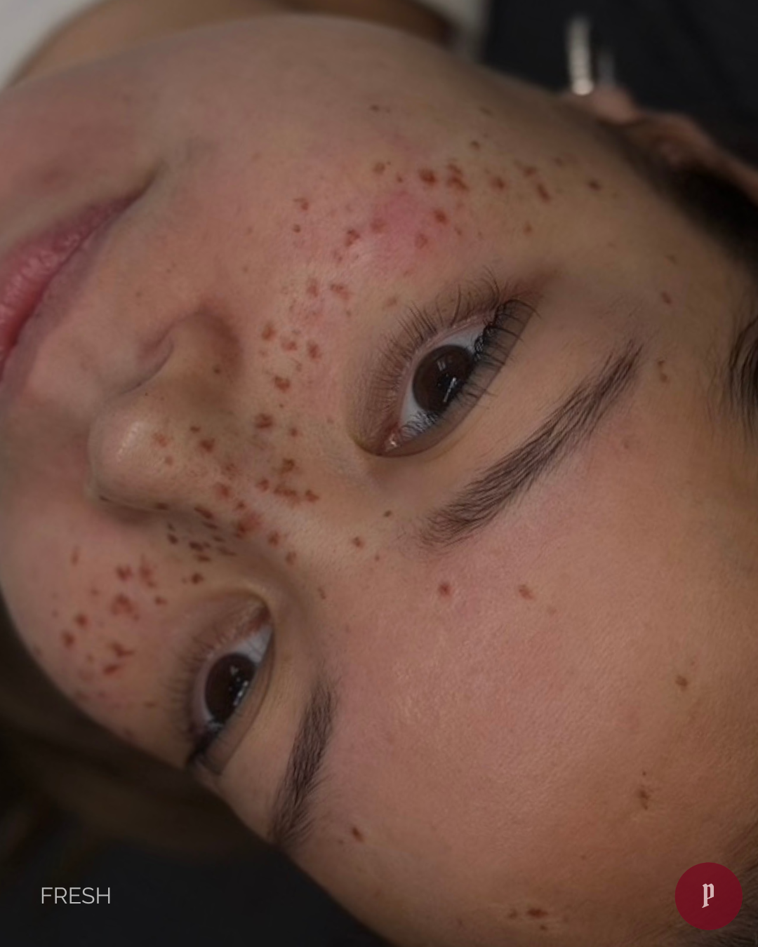 freckle tattoo melbourne
