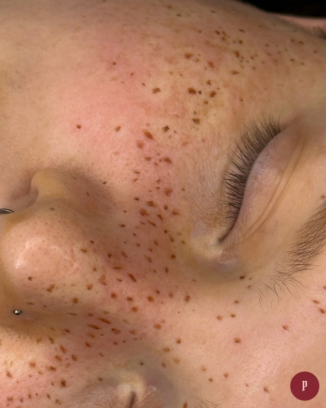 Freckle tattoo melbourne
