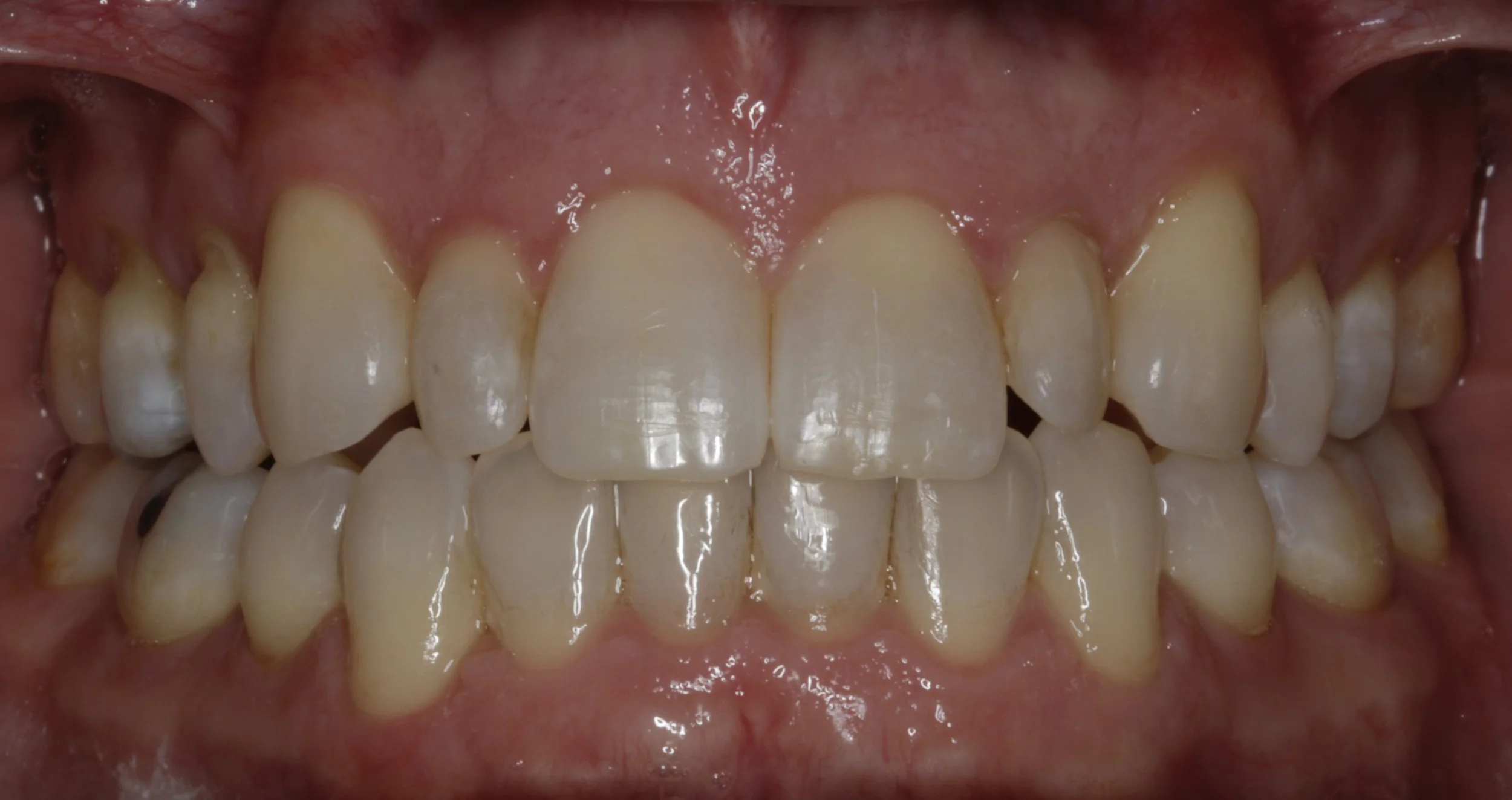 Close-up of open mouth showing upper and lower teeth with some plaque and discoloration.