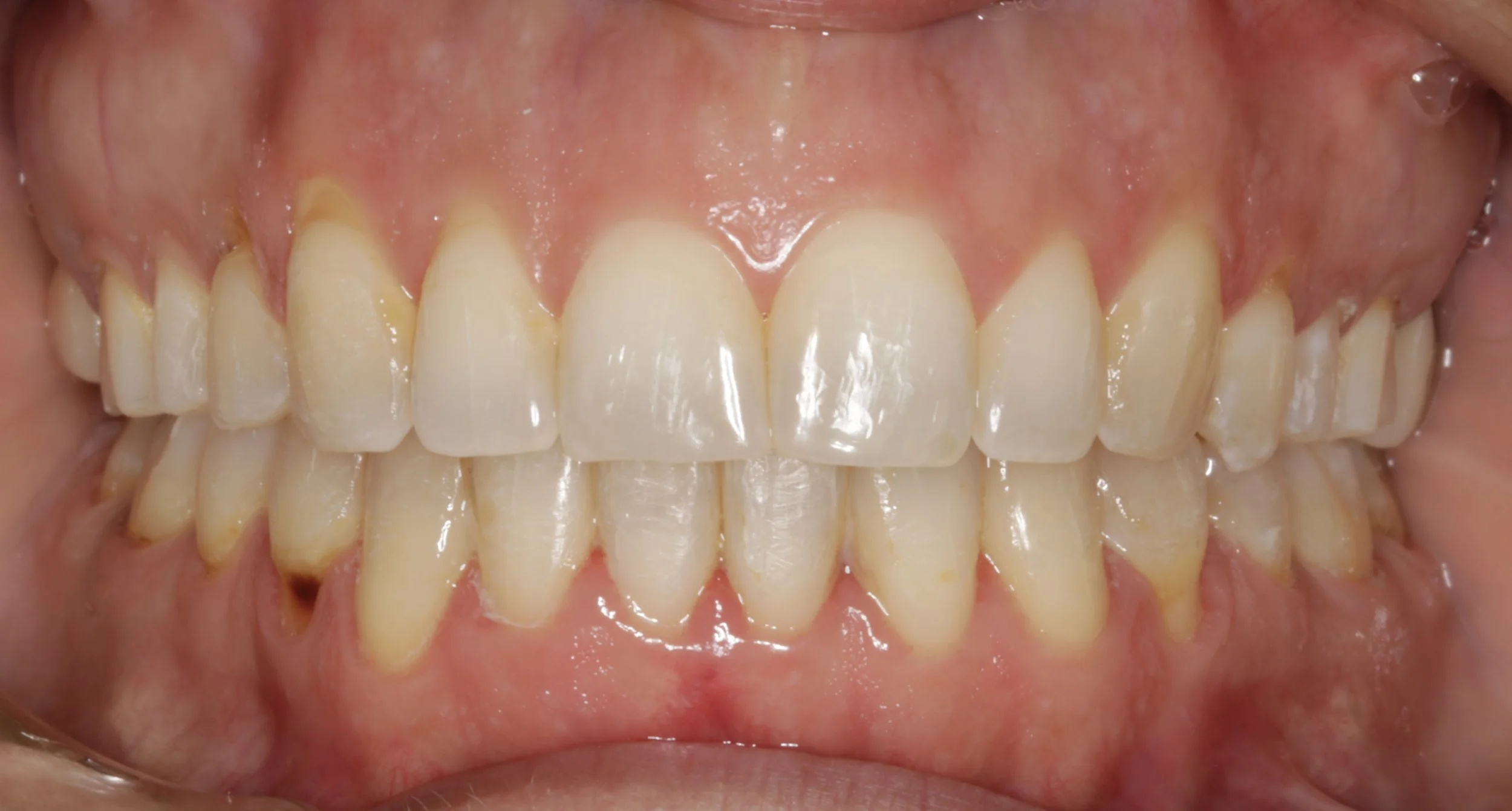 Close-up of a person's teeth showing the upper and lower sets with some minor crowding and plaque buildup on some teeth.