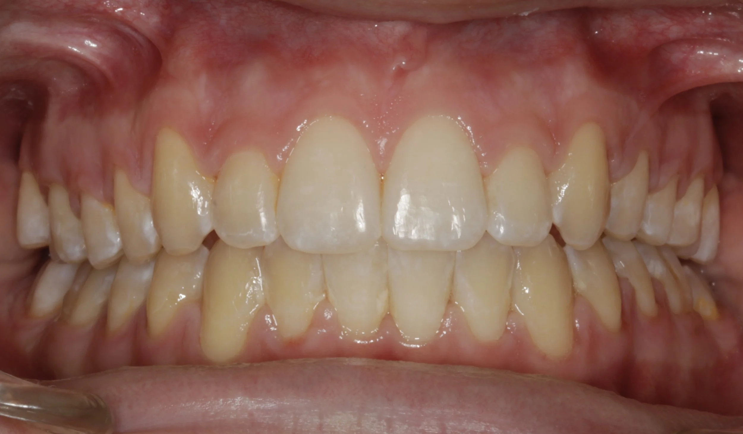 Close-up of a person's mouth showing upper and lower teeth with some minor discoloration and gum redness.