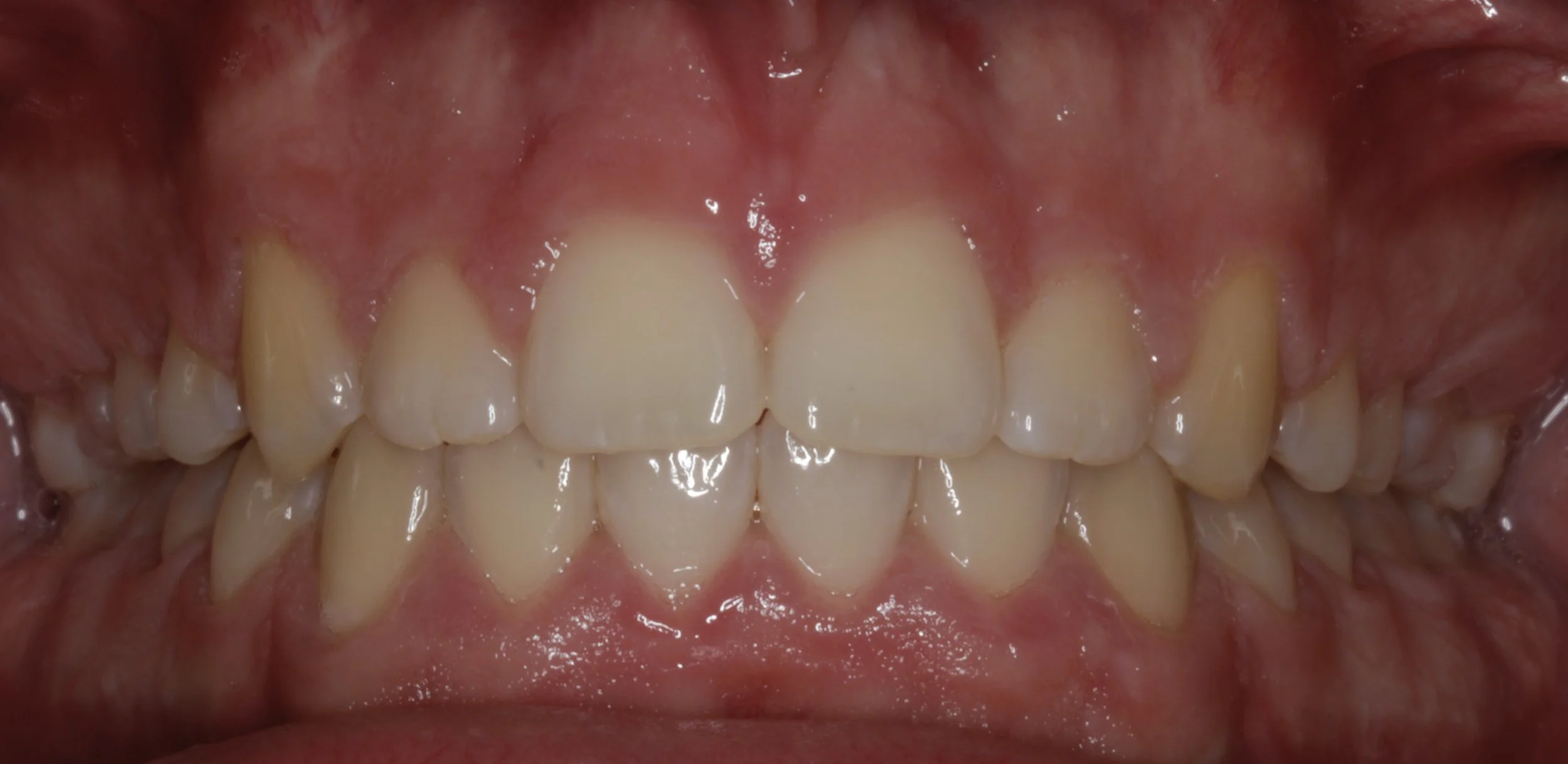 Close-up of human teeth and gums, showing upper and lower teeth with some slight yellowing and overlapping, along with pink gum tissue.