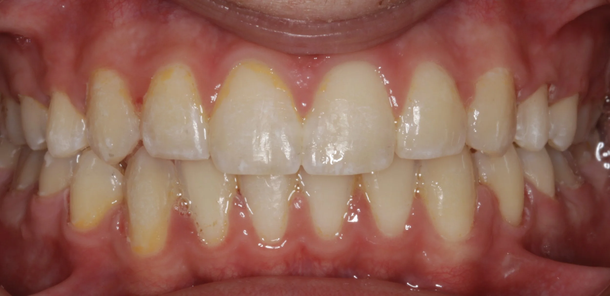 Close-up of human teeth showing enamel wear and plaque buildup