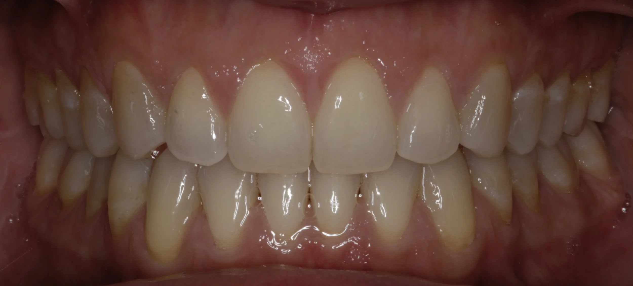 Close-up of a person's teeth showing both upper and lower teeth, with the upper front teeth being prominently visible.