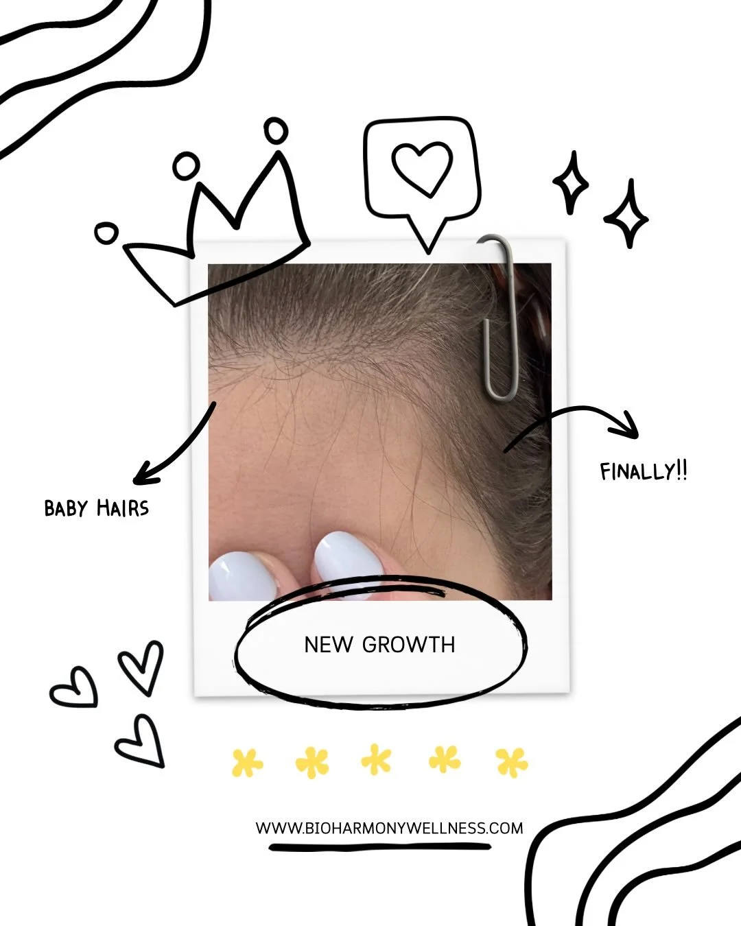 🫰🫰At our age.. Baby hairs are an AMAZING sign!! I love how our recommended regimen is showing results. Because results are what matter. 
.
.
#hairlossproblem #scalphealth #womenshealthmatters #prospertxmoms