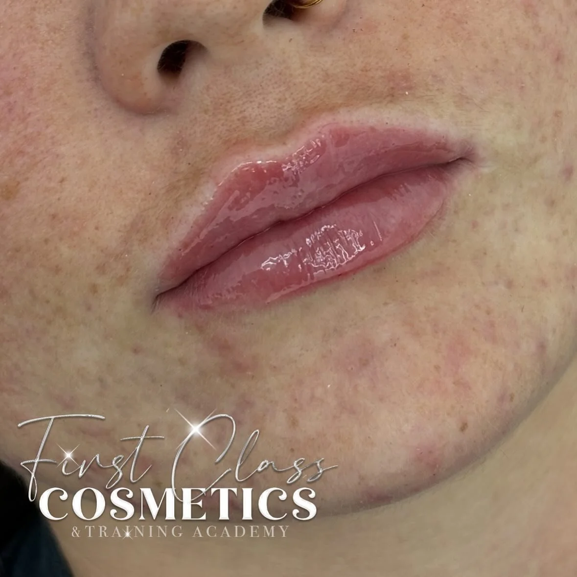 Cutest little top up before Christmas 🎄

❔1ml lip filler 
💸 &pound;100
🔍 @luxfill_uk 
📍219 St Marks Road, DY4 0SZ

 📱07864362118 for enquiries 
Booking link can be found in our bio🤍

#lipfillersuk #luxfil #dermalfiller