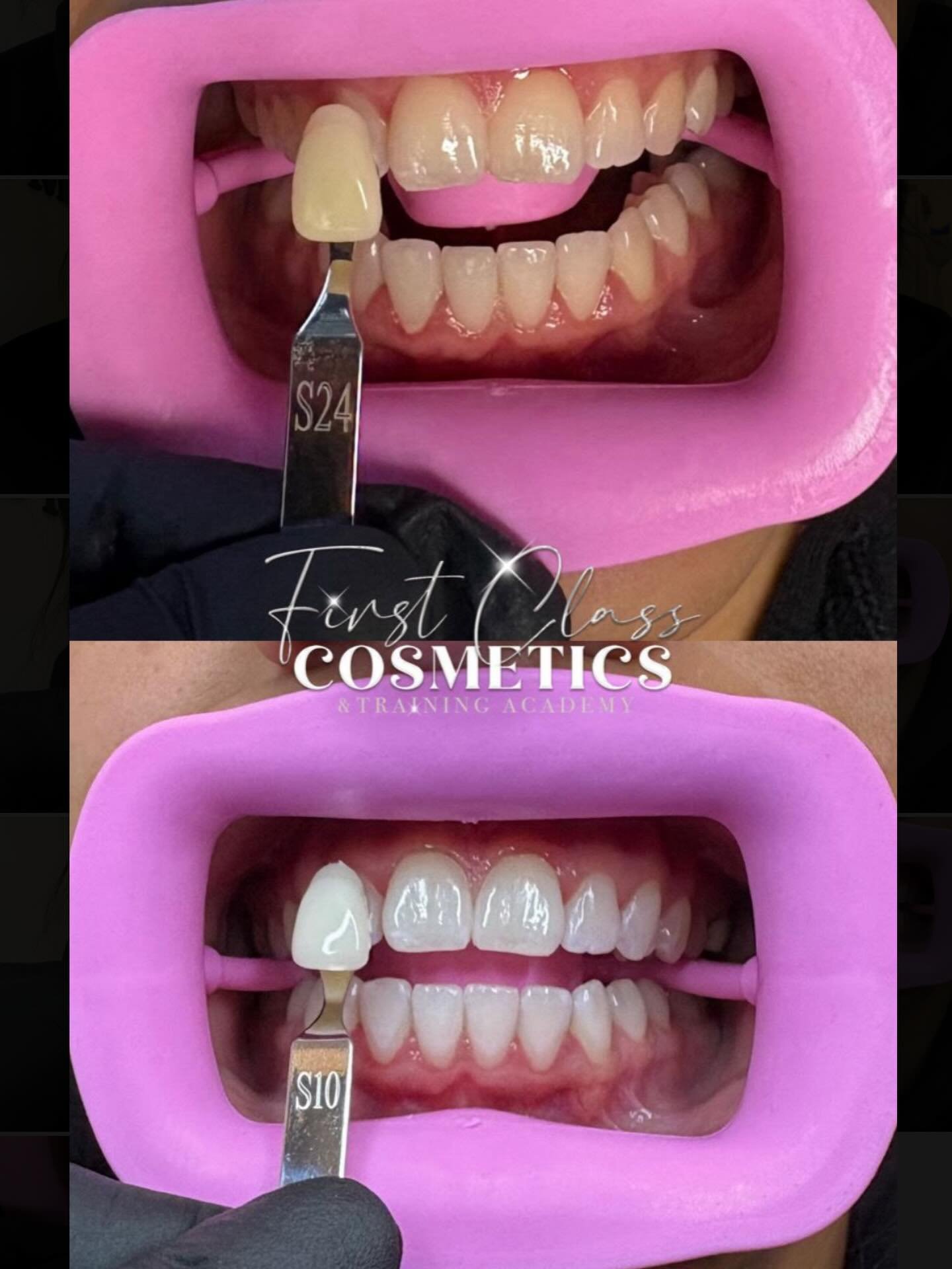 🦷 ✨ 

Insane results from just one 60 minute session of teeth whitening, 14 shades lighter giving our clients brighter and happier smiles😁 

Teeth whitening will be available to book via the website very soon⏳

❔Teeth whitening (60 minute session)
