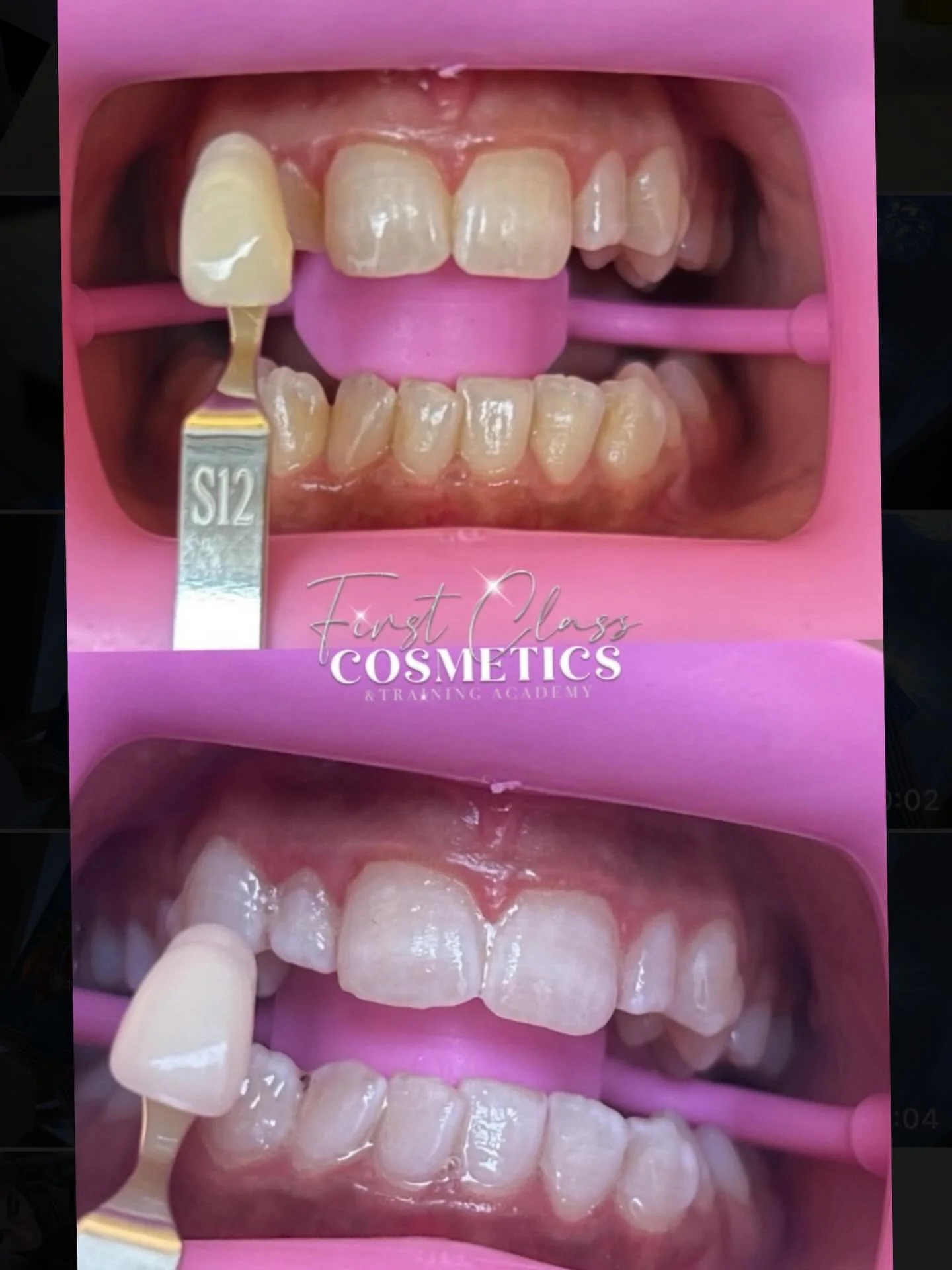 When the results speak for themselves 🦷✨

Get your teeth up to 16 shades whiter with our cosmetic teeth whitening treatment🤞🏻

Currently on offer for &pound;70💸

❔Teeth whitening 
💸 &pound;100
📍Tipton, DY4 

#teethwhiteningqueens #pearlywhites