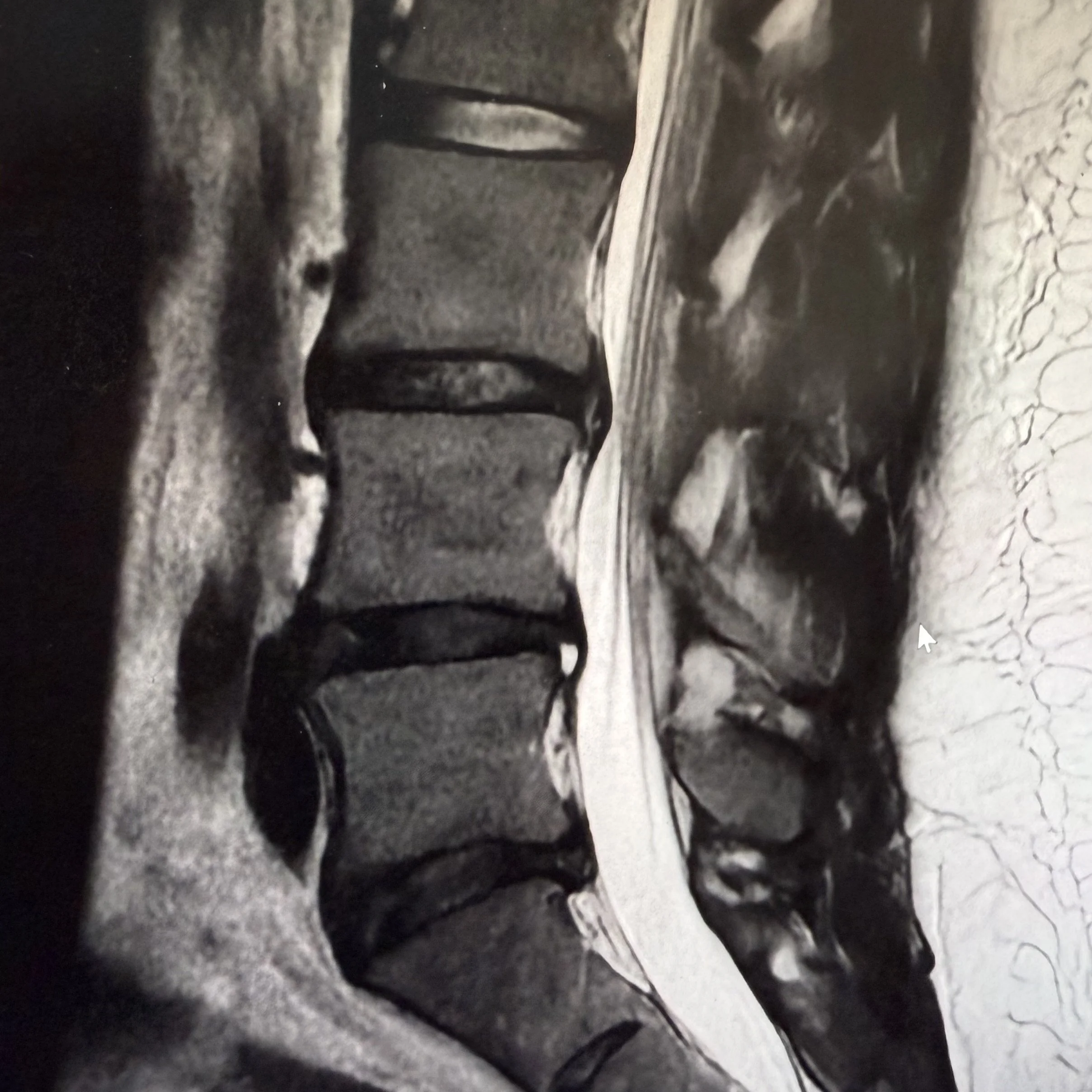 Disc Herniation: Symptoms, Treatment, and When to See a Chiropractor