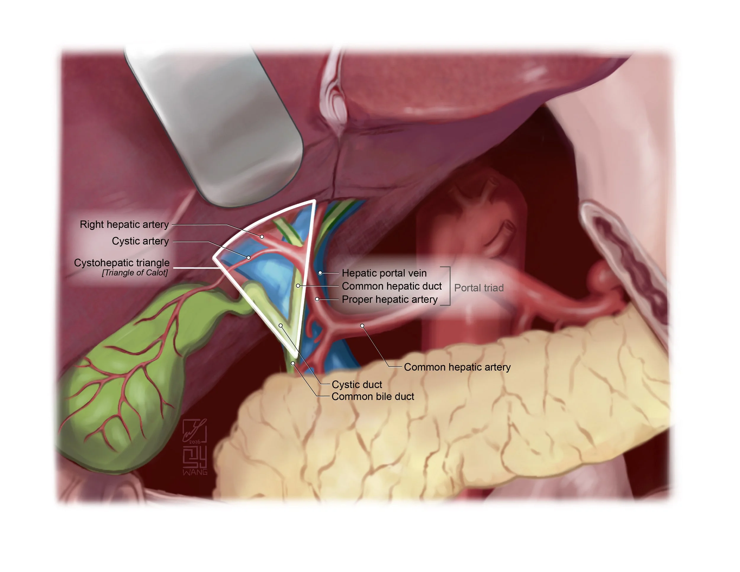 Cystohepatic triangle [Triangle of Calot]