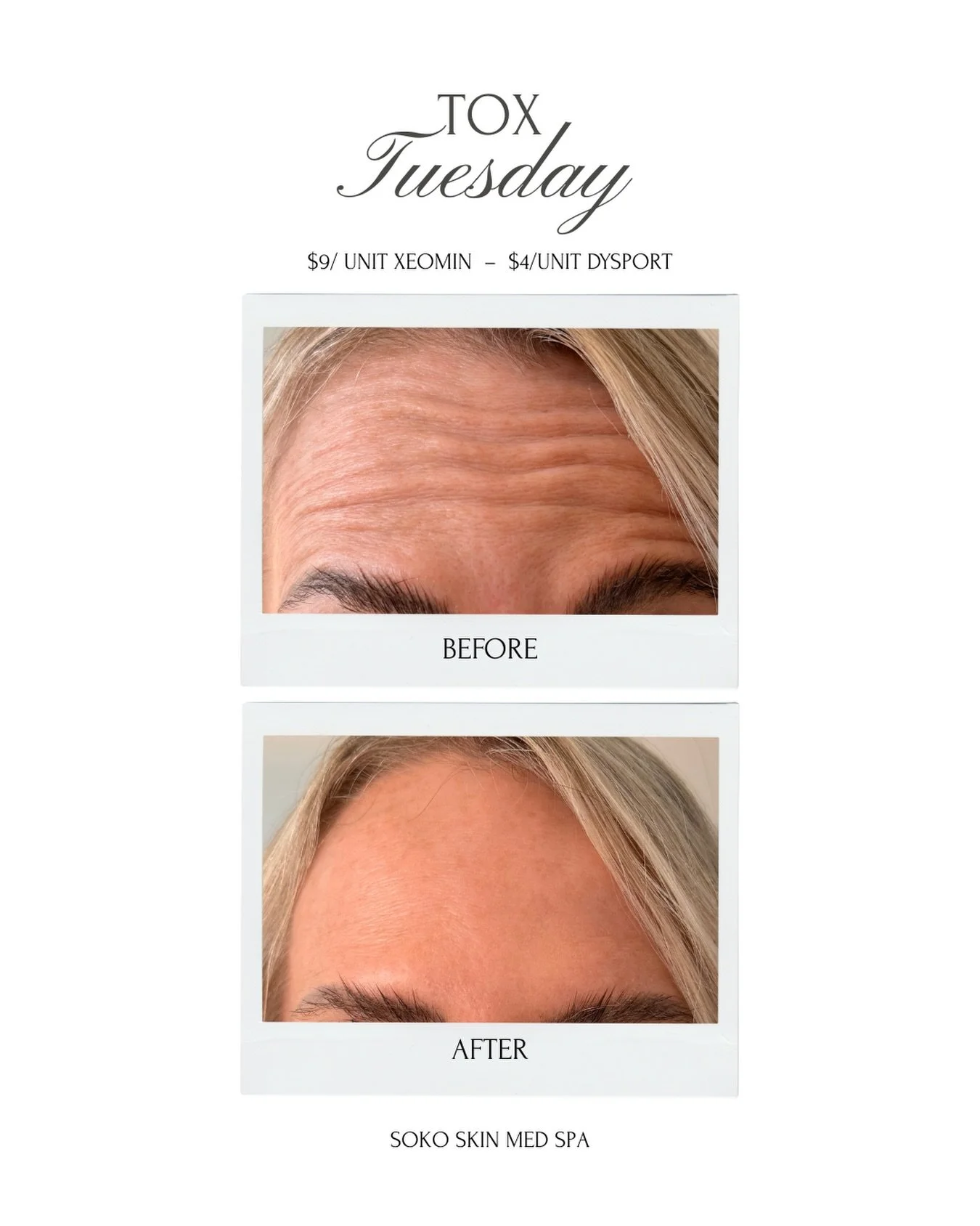 Smooth, natural, refreshed ✨
 Tox Tuesday at Soko Skin Med Spa!

 💉 Weomin $9/unit
 💉 Dysport $4/unit
 Schedule your visit and glow with confidence🫶