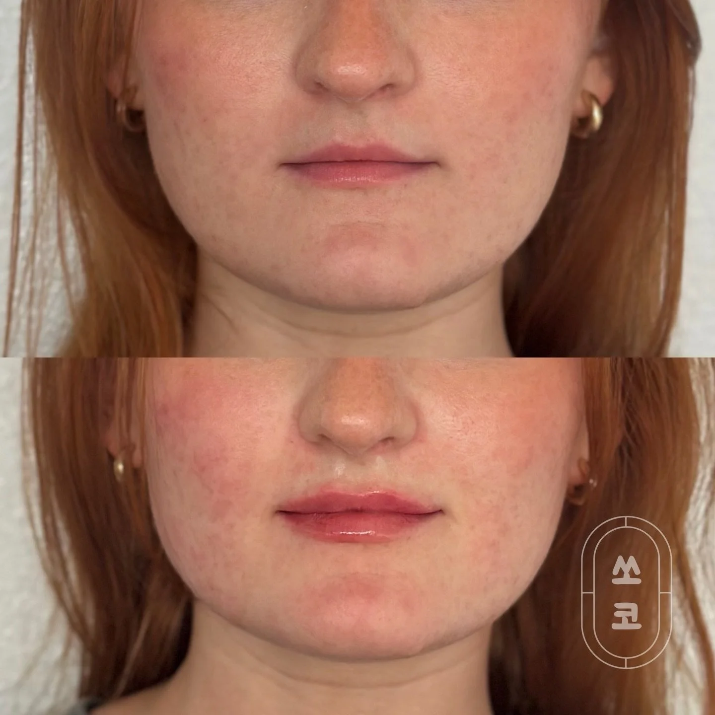 At Soko Skin we love how a subtle touch of lip filler can enhance the natural shape of the lips, giving them a soft, defined, and beautifully balanced look💋

This before &amp; after shows just how pretty a gentle, customized result can be!✨

‼️Frien