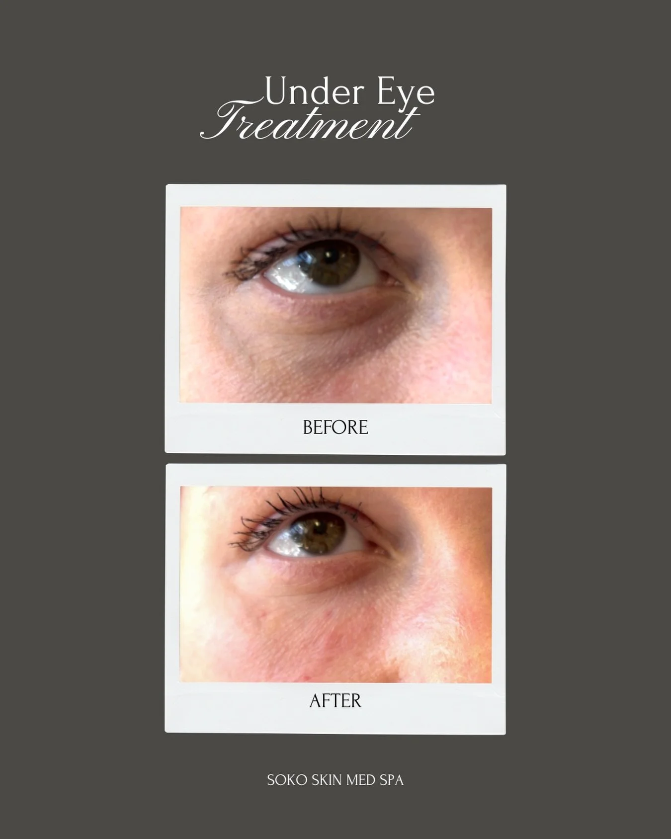 Our under eye treatment is designed to refresh, smooth, and brighten the most delicate area of your face 🤍

 Helping you look rested, radiant, and like yourself again.
DM us for more info!