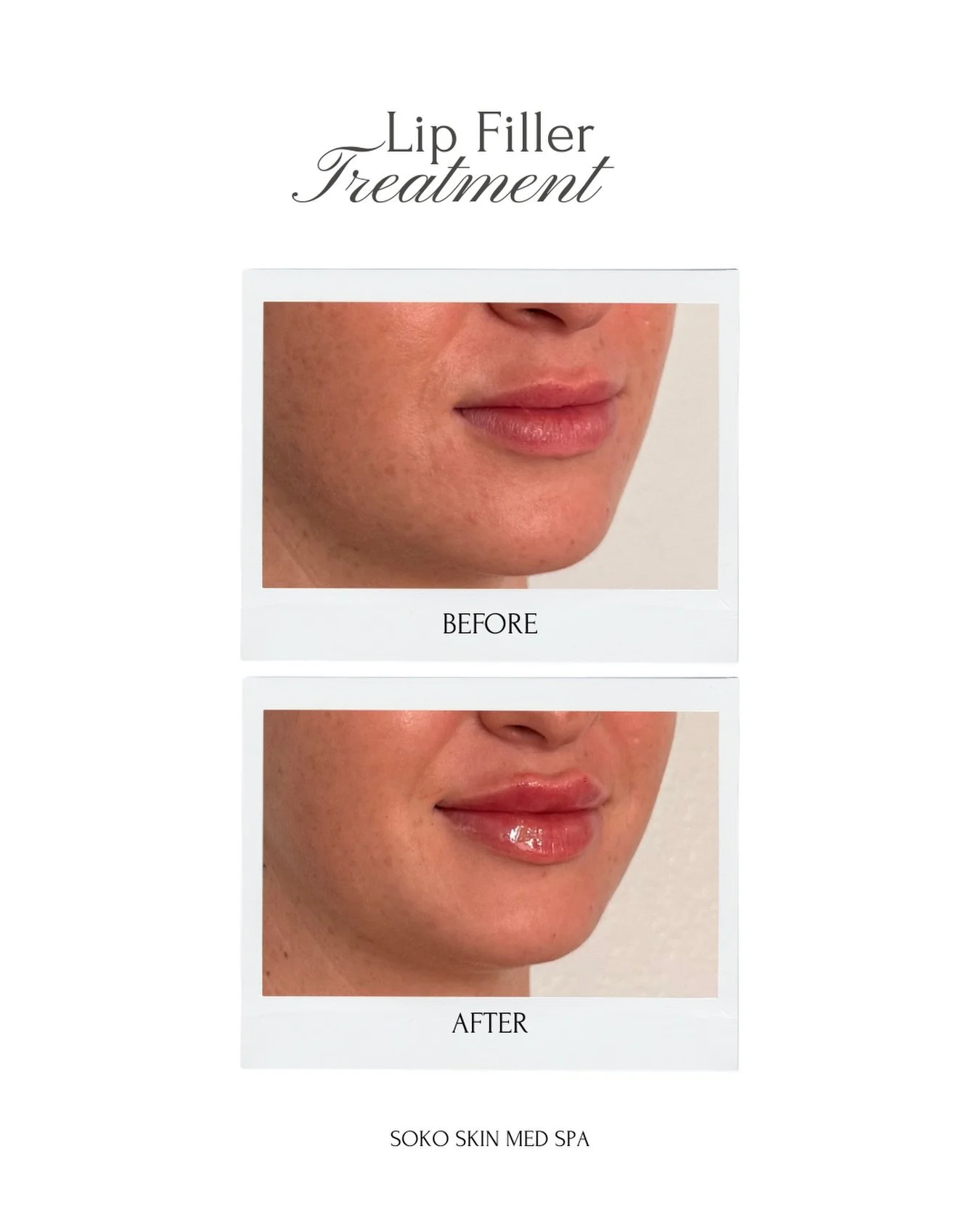 Enhance your natural beauty with our Lip Filler appointments🤍 

Whether you&rsquo;re looking for subtle volume, added hydration, or more defined lips, we create results that are balanced, beautiful, and customized just for you.

📍8753 E Bell Rd, St
