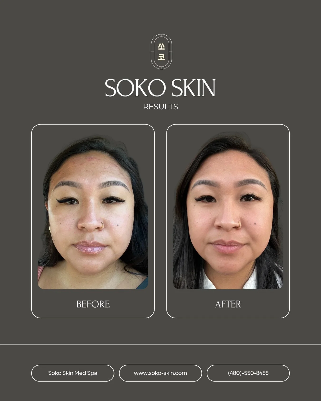 This is the result after 4 facial sessions designed to deeply cleanse, hydrate, and improve overall skin texture 🤍 

Consistency + professional treatments + the right skincare routine = glowing, healthy skin.

Every skin journey is different, but re