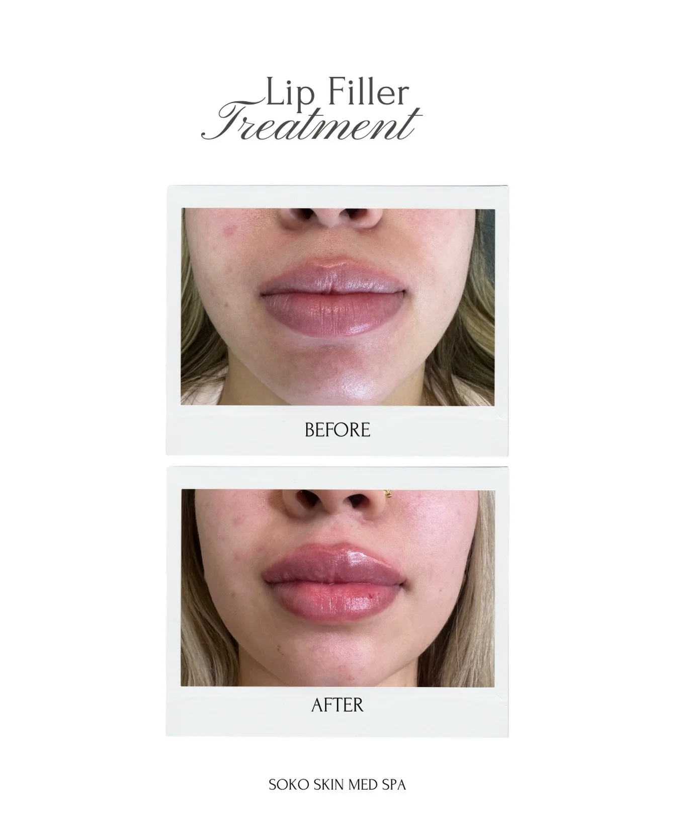 Enhance your natural beauty with expertly placed lip filler for a balanced, hydrated, and fuller look! 

Results are customized to your unique facial features for soft, natural-looking volume.

✨ Book your FREE consultation

#LipFiller #LipEnhancemen