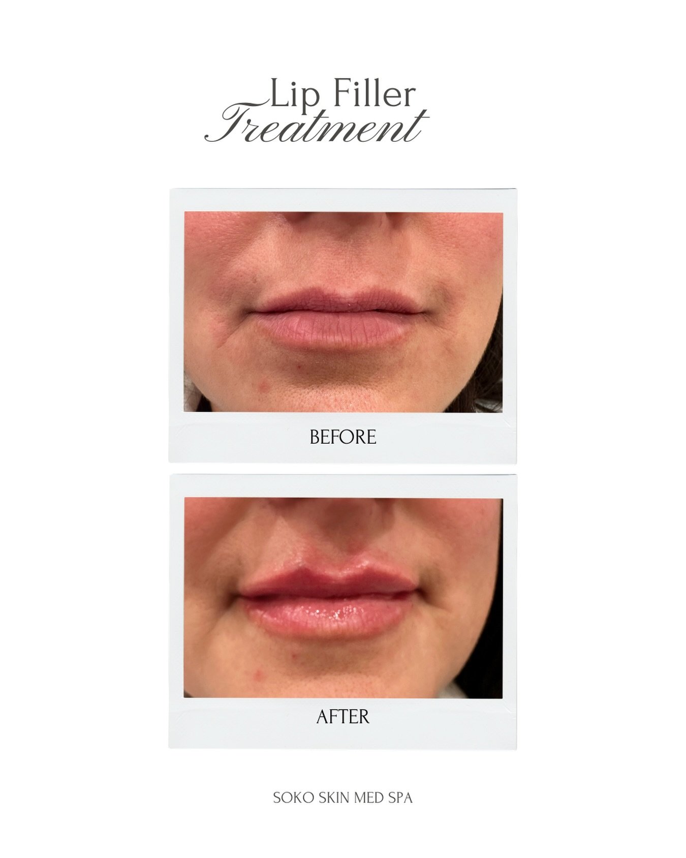 Enhance your natural beauty with expertly placed lip filler for a balanced, hydrated, and fuller look!

Results are customized to your unique facial features for soft, natural-looking volume.

🤍Book your FREE consultation

#LipFiller #LipEnhancement